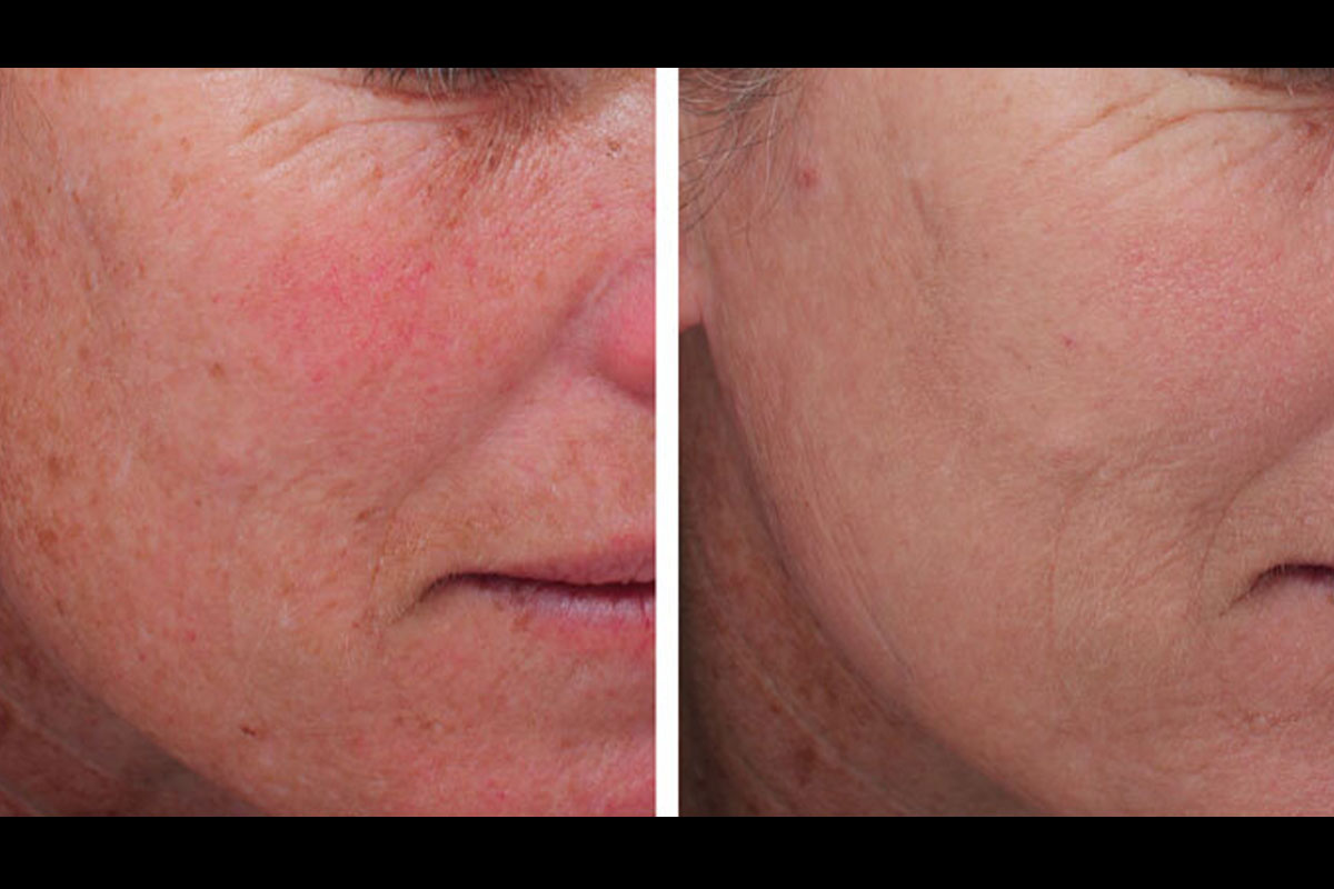 before and after MOXI laser in Austin