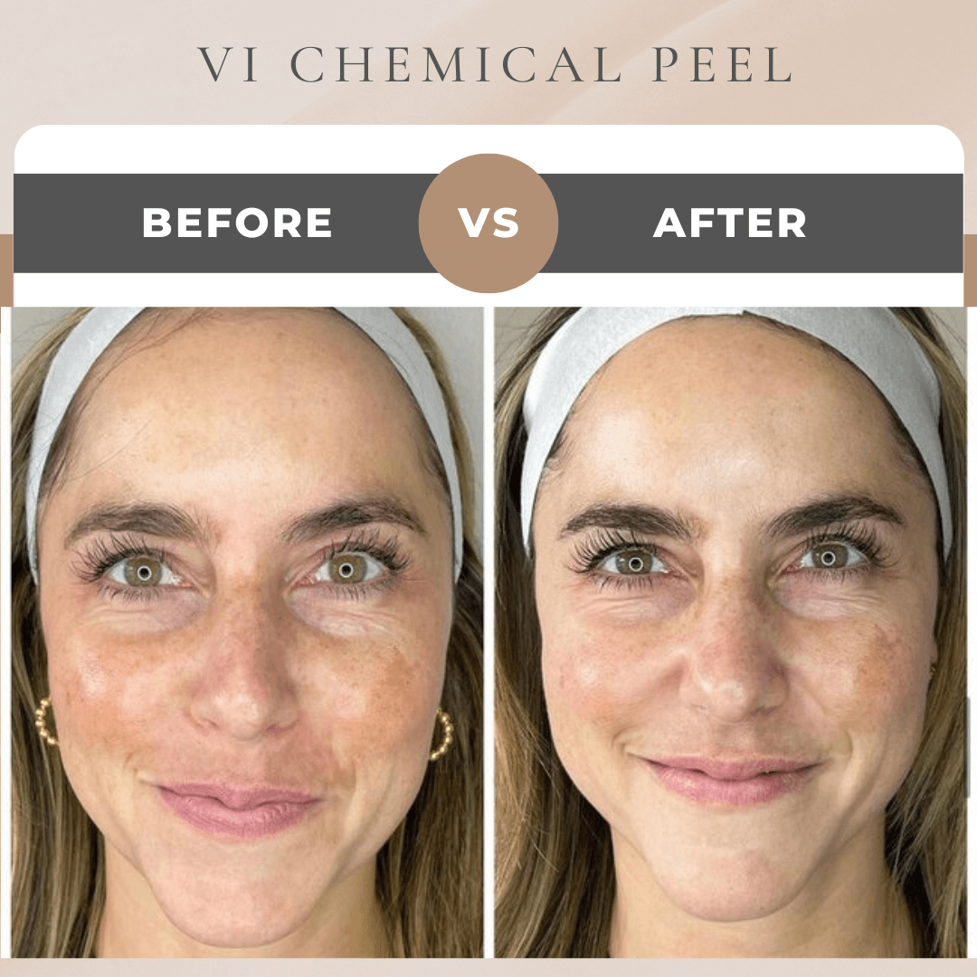 chemical peels before and after