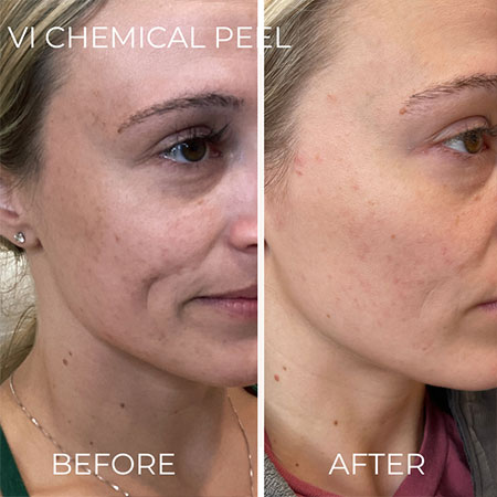 a woman's before and after images after getting a VI peel in Austin