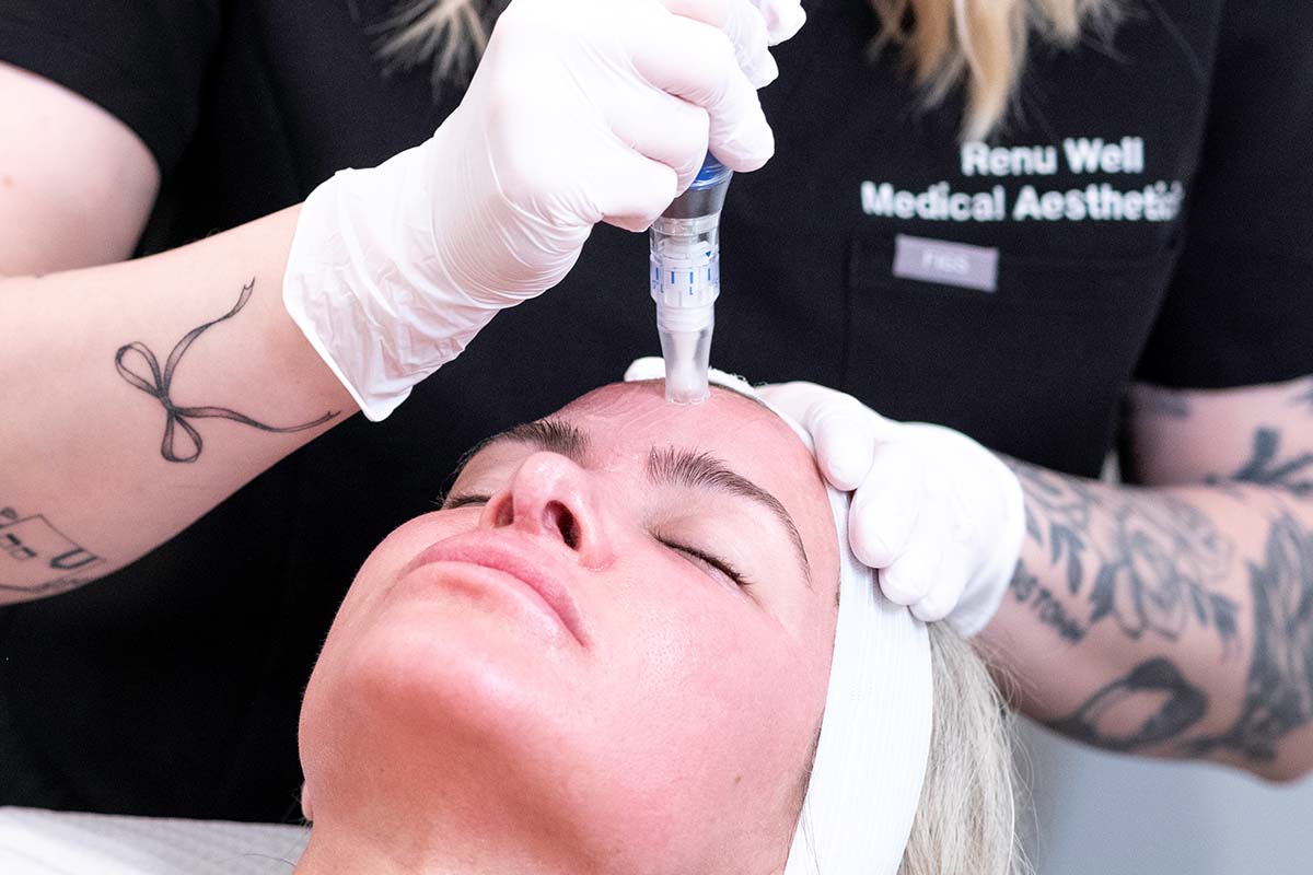 a woman lies on a table with her eyes closed and she receives skinpen microneedling in Austin